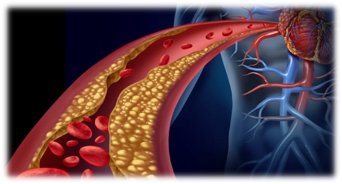Lipidomics for Cardiovascular Diseases Research