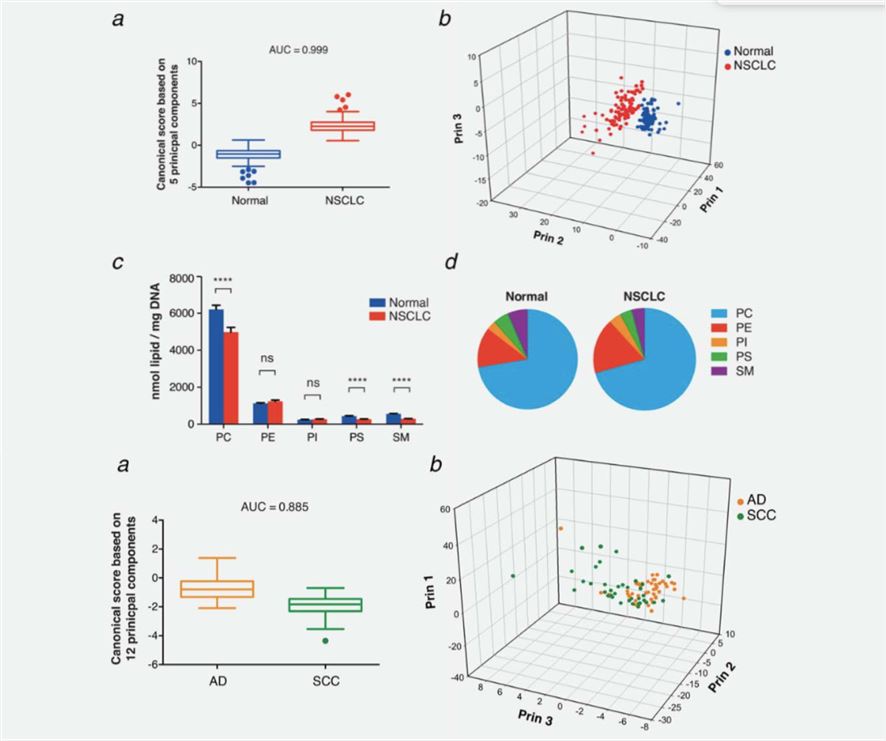 Phospholipid profiles discriminate NSCLC versus normal tissues and AD versus SCC tumors