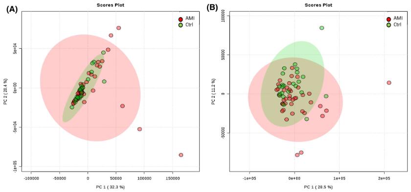 Pincipal component analysis (PCA) of lipids extracted from monocytes isolated from AMl patients and control subjects